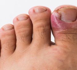 درمان تخصصی ناخن فرورفته در گوشت پا