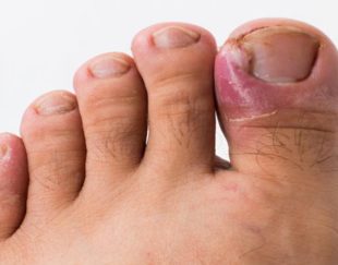 درمان تخصصی ناخن فرورفته در گوشت پا